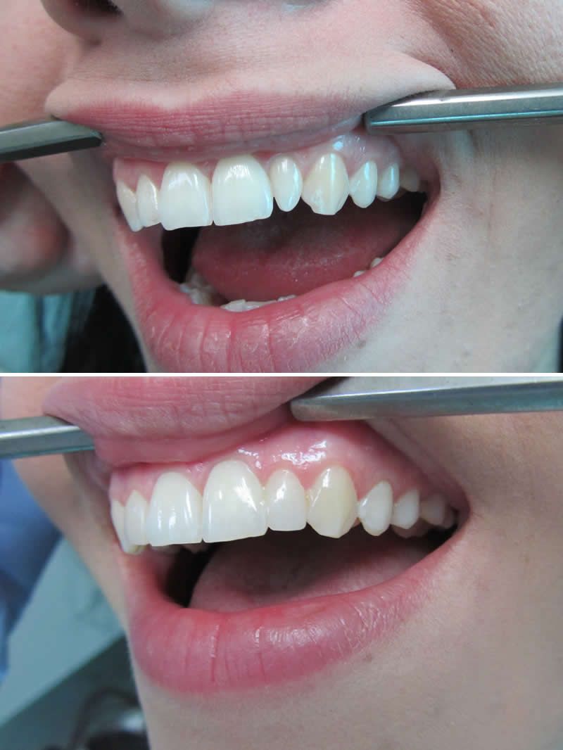 ХУДОЖЕСТВЕННАЯ РЕСТАВРАЦИЯ ЗУБОВ