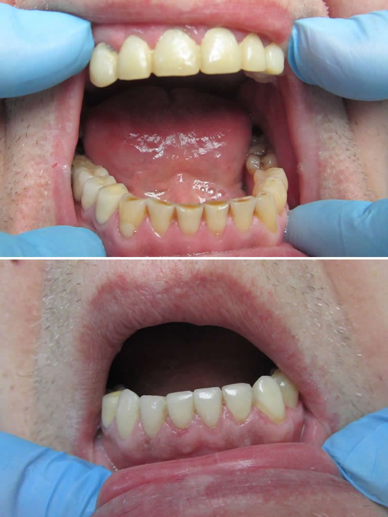 ХУДОЖЕСТВЕННАЯ РЕСТАВРАЦИЯ ЗУБОВ