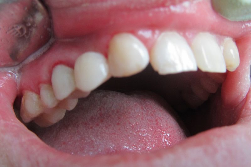 Адгезивные протезы после