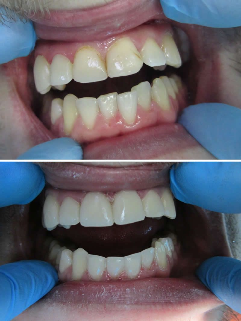 ХУДОЖЕСТВЕННАЯ РЕСТАВРАЦИЯ ЗУБОВ