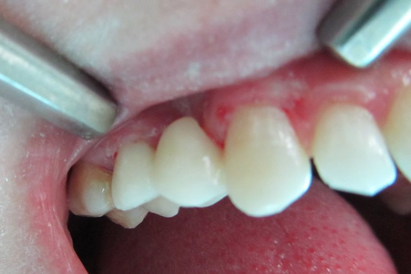 Трансформация зубов после