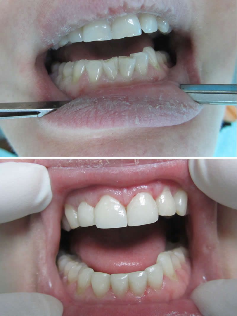 ХУДОЖЕСТВЕННАЯ РЕСТАВРАЦИЯ ЗУБОВ