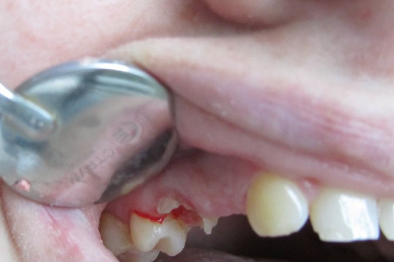 Адгезивные протезы до