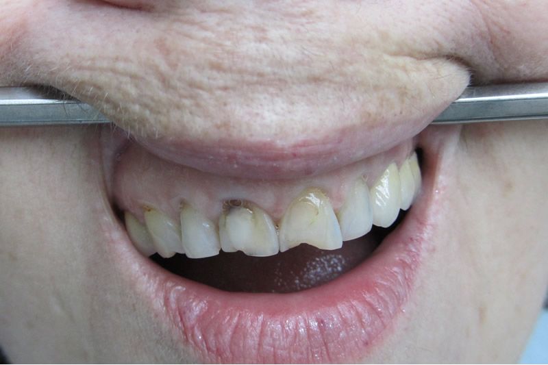 Реставрация зубов до